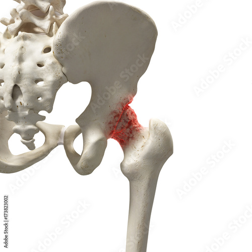 3d rendered medically accurate illustration of an arthritic hip joint photo