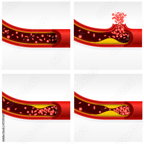 Artery section with cholesterol and thrombosis, cerebral stroke and heart attack