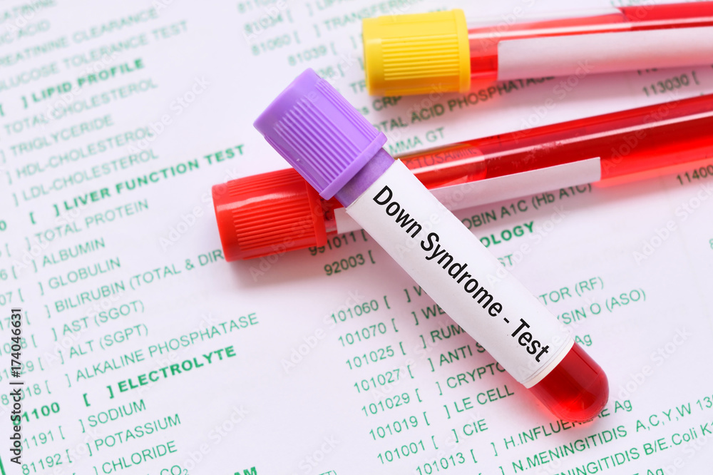 blood-sample-for-down-syndrome-test-stock-photo-adobe-stock