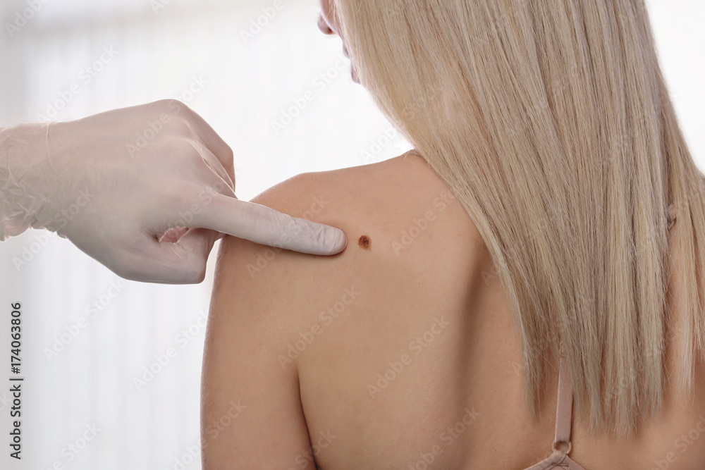 Doctor dermatologist examines birthmark of patient. Checking benign moles.