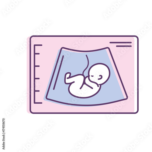 ultrasound of baby with umbilical cord