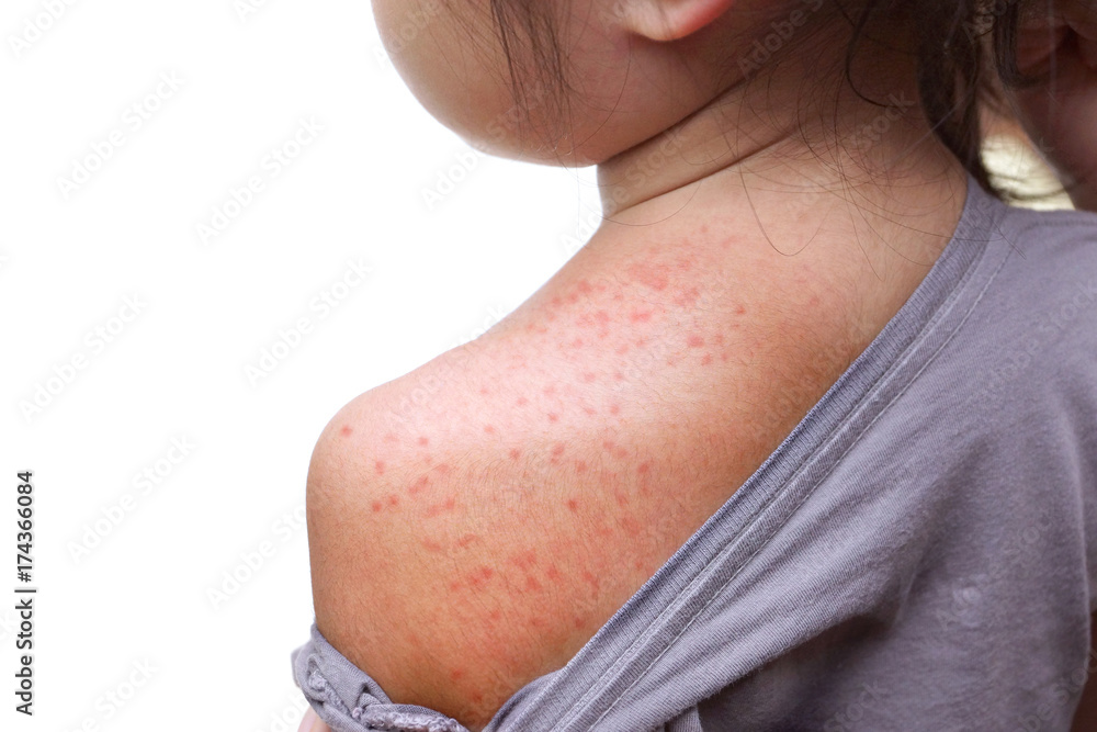 Red rash on baby skin at the back / Roseola infantum / Exanthema subitum / rose rash of infants / sixth disease / baby measles / three-day fever - obrazy, fototapety, plakaty 