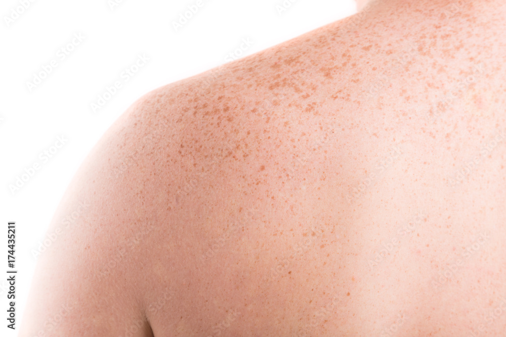 Freckles on back of man closeup on white background. Pigmentation and lot of birthmarks on male shoulders. Skin problems Freckles on back of man closeup on white background. Pigmentation and lot of birthmarks on male shoulders. Skin problems