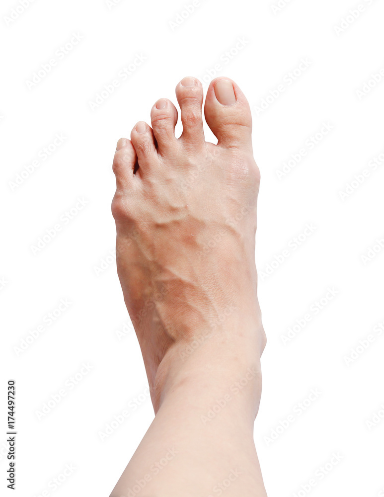 Left bunion - hallux valgus on white background and clipping path Left bunion - hallux valgus on white background and clipping path