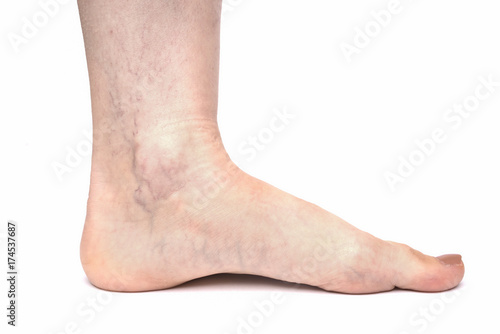 Varicose veins on female leg isolated on white background
