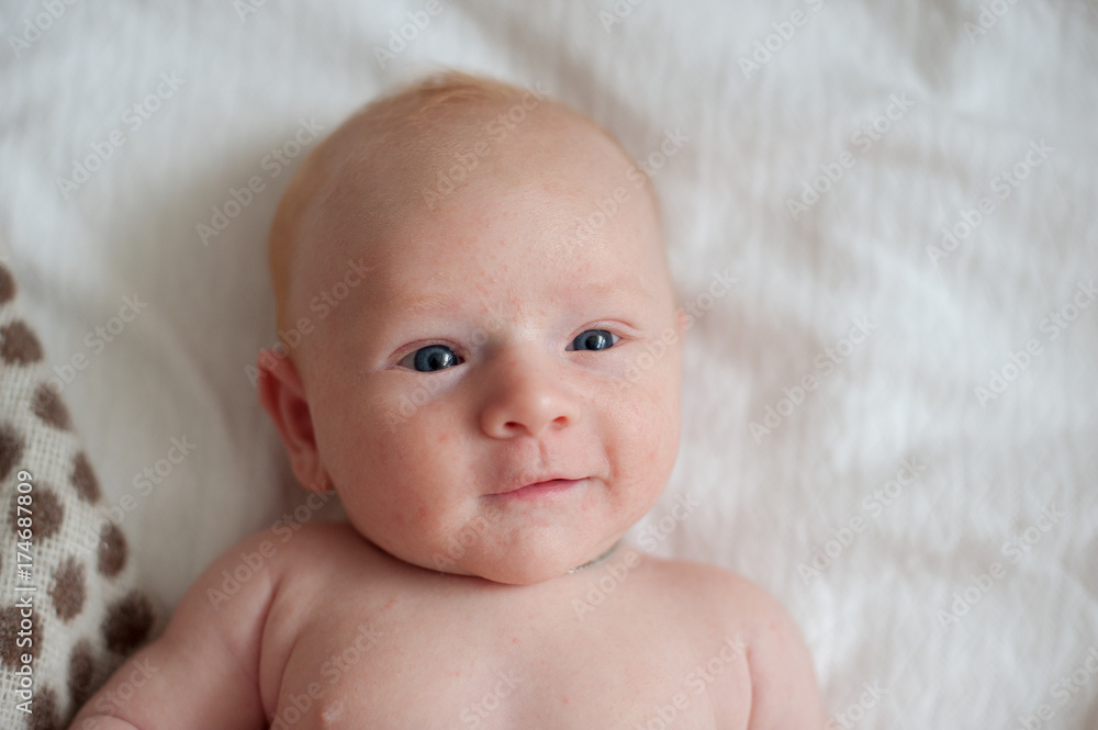 Newborn baby with a rash on the face, dermatitis Newborn baby with a rash on the face, dermatitis