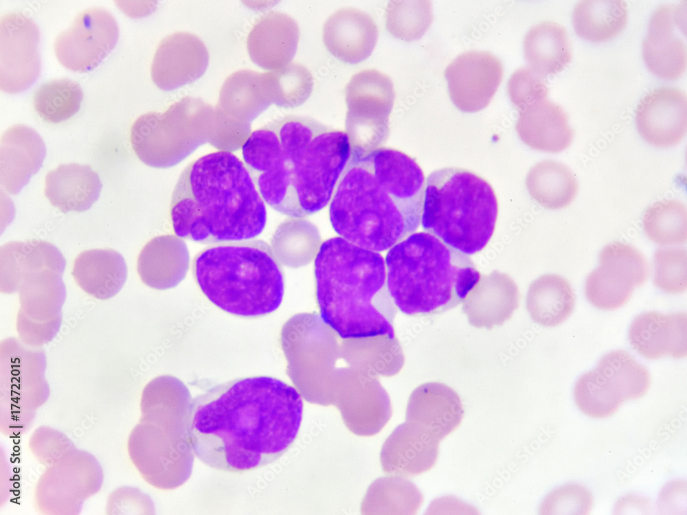 Blood picture of acute myeloid leukemia (AML), analyze by microscope
