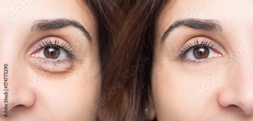 Woman eye before and after cosmetic treatment with and without eye bag