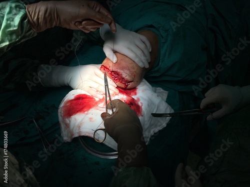 Amputation surgery