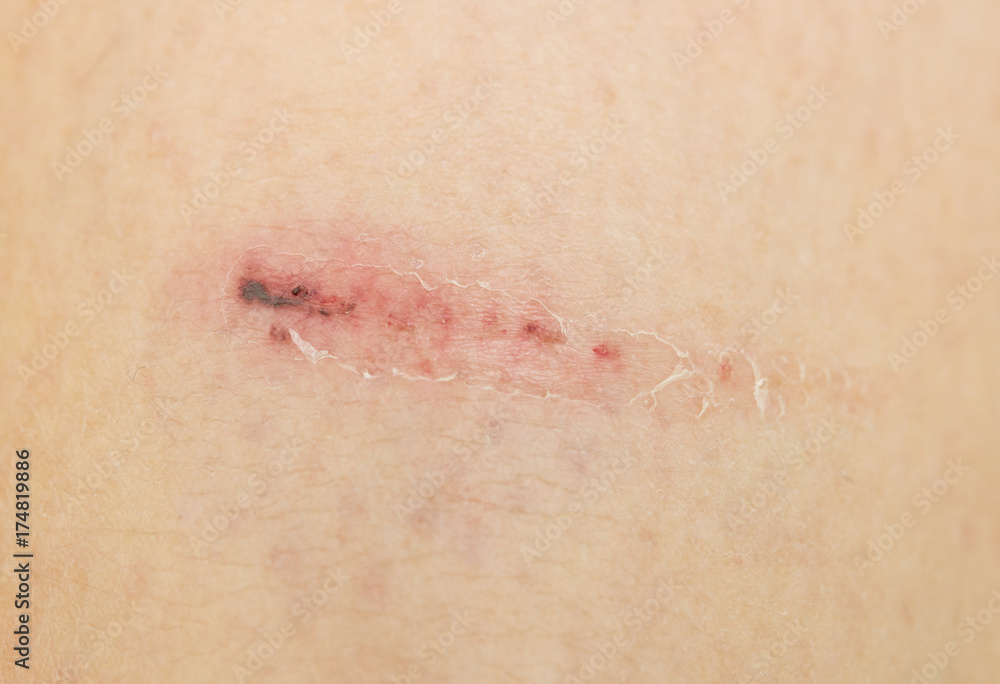 Fototapeta premium scraped skin