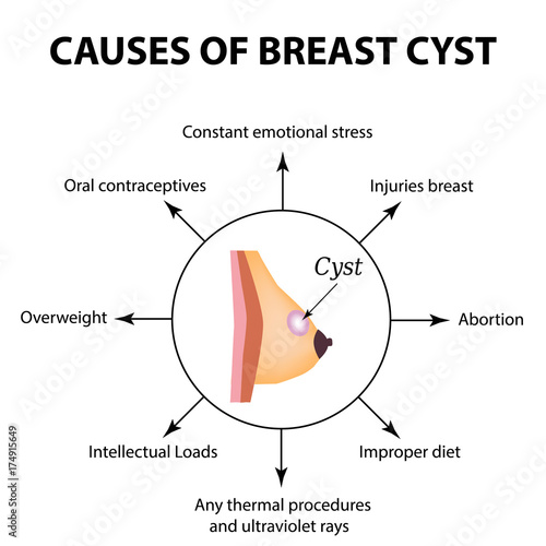 Causes of cyst in the mammary gland. World Breast Cancer Day. Tumor. Vector illustration on isolated background