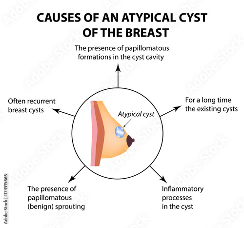Causes of an atypical cyst in the mammary gland. World Breast Cancer Day. Tumor. Vector illustration on isolated background