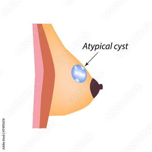 Atypical cyst of the breast. Mammary gland. World Breast Cancer Day. Vector illustration on isolated background