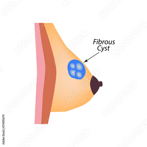 Fibrous cyst breast. World Breast Cancer Day. Tumor of the mammary gland. Vector illustration on isolated background