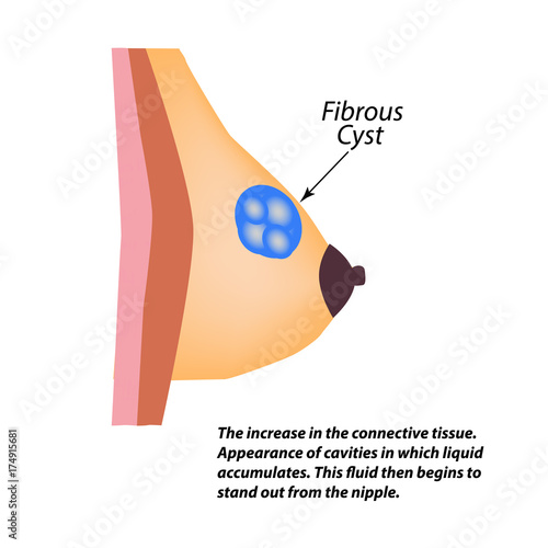 Fibrous cyst breast. World Breast Cancer Day. Tumor of the mammary gland. Vector illustration on isolated background