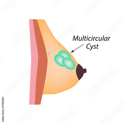 Multicameral cyst. World Breast Cancer Day. Tumor. Vector illustration on isolated background