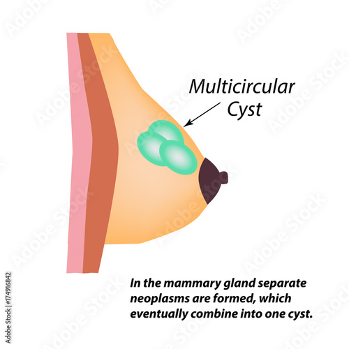 Multicameral cyst. World Breast Cancer Day. Tumor. Vector illustration on isolated background