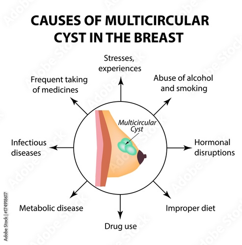 The causes of multicameral cyst. World Breast Cancer Day. Tumor. Vector illustration on isolated background