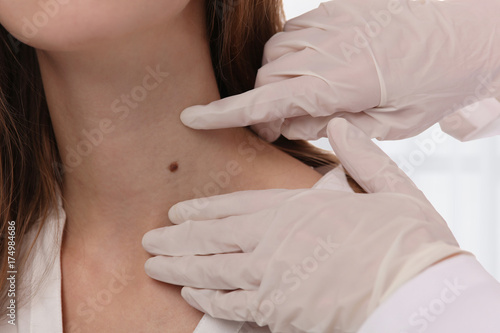 Foto Doctor dermatologist examines birthmark of patient close up