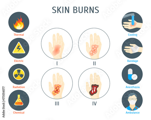 Human Skin Burns Infographic Card Poster. Vector