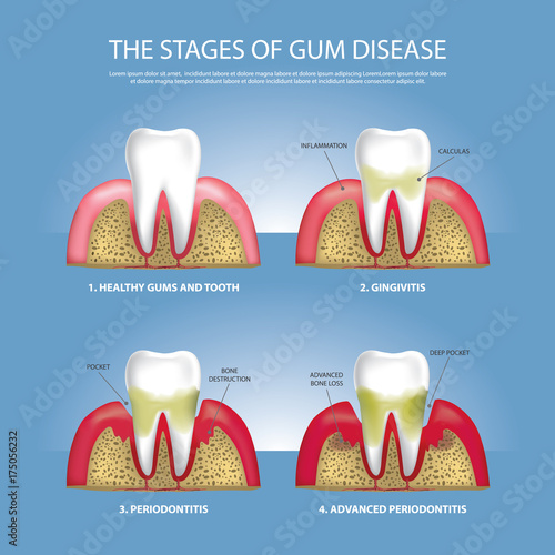 Human teeth Stages of Gum Disease Vector Illustration