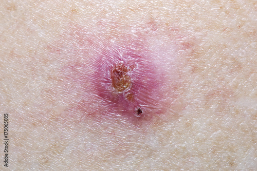 Basal Cell Carcinoma on a mature female  photo