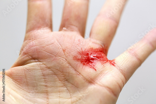 Canvas Print Close up of a bleeding cut hand with tiny shards of glass.