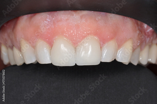 Close up of a patient's upper row of teeth at a dental clinic