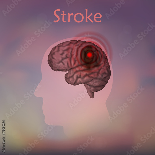 Stoke poster, banner. Vector medical illustration. Blurred background, pink silhouette of man head, anatomy image of damaged human brain.
