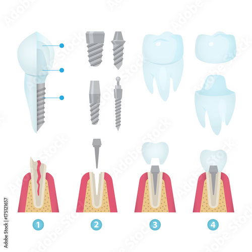 Dental crowns and implantation