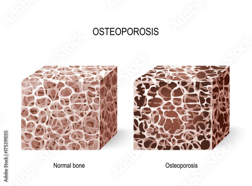 Osteoporosis. Bone tissue