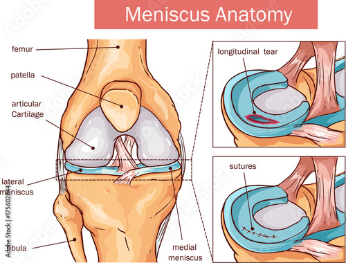 vector illustration of a Meniscus tear and surgery photo