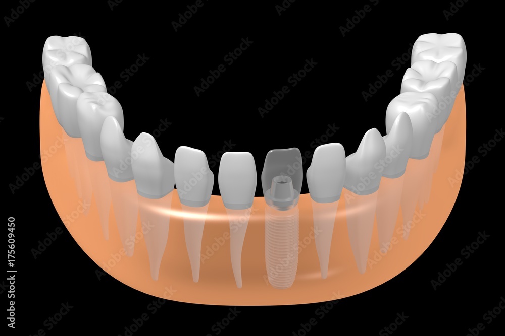 Fototapeta premium Dental implant/ tooth implant