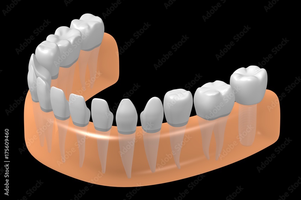 Fototapeta premium 3D dental implant