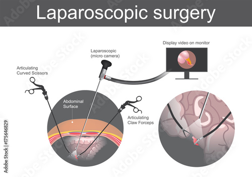 Laparoscopic surgery. Technical surgery which operations are performed far from their location through small incisions in abdominal surface or the body. Large Intestine system, Illustration body parts