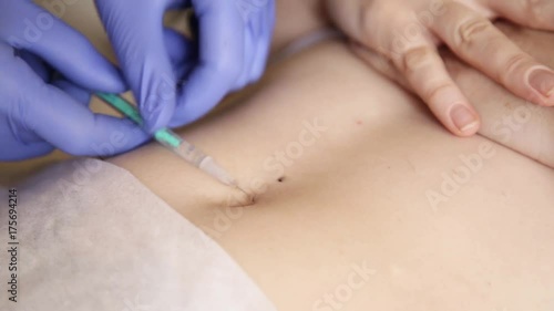 Operation to install navel piercing. doctor makes navel puncture photo