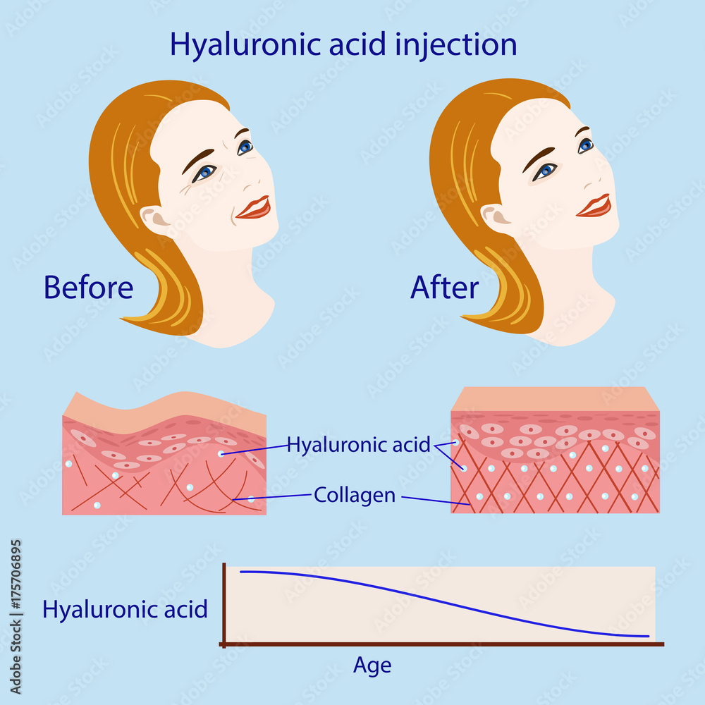 hyaluronic acid injection, before and affect , vector illustration