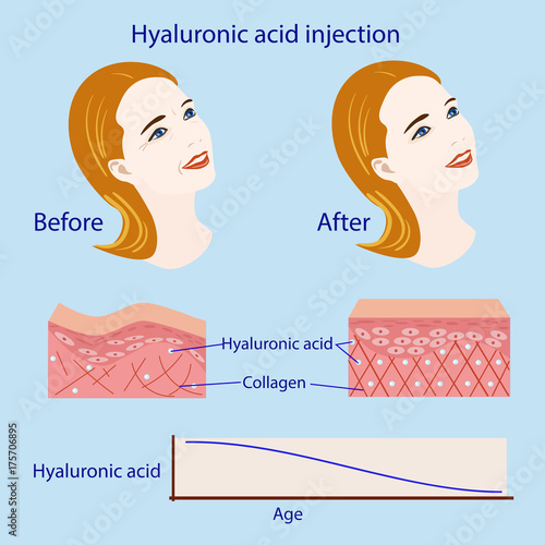 hyaluronic acid injection, before and affect , vector illustration, diagram