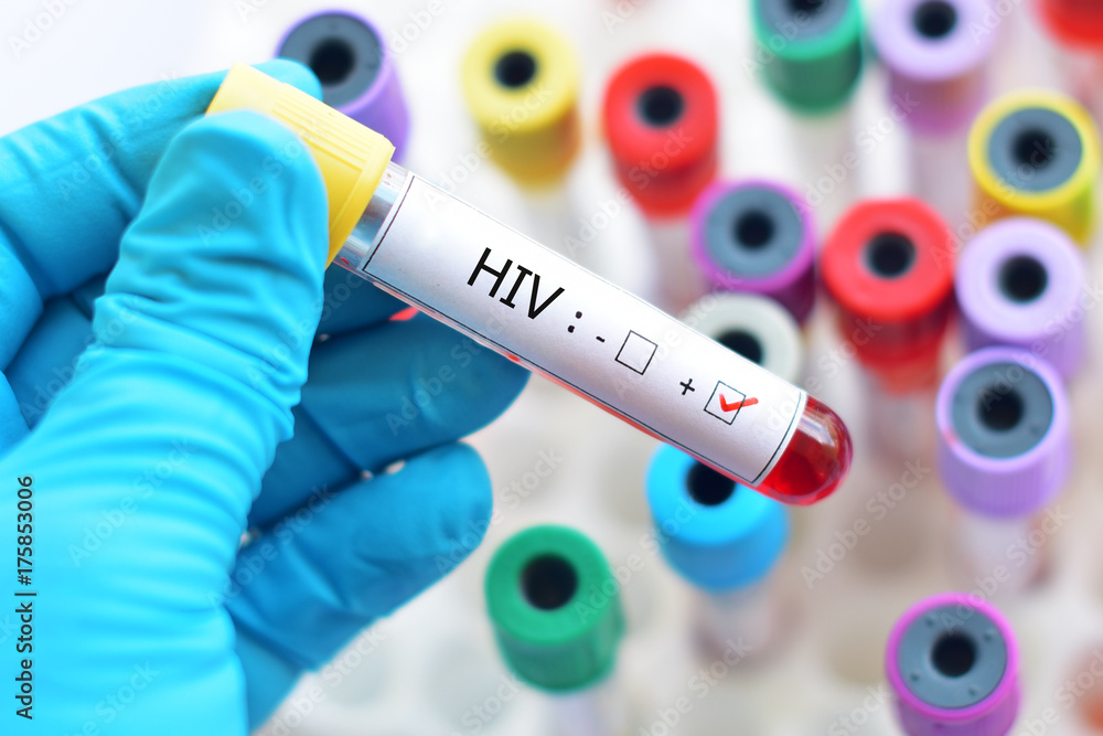 Fototapeta premium Blood sample positive with HIV 