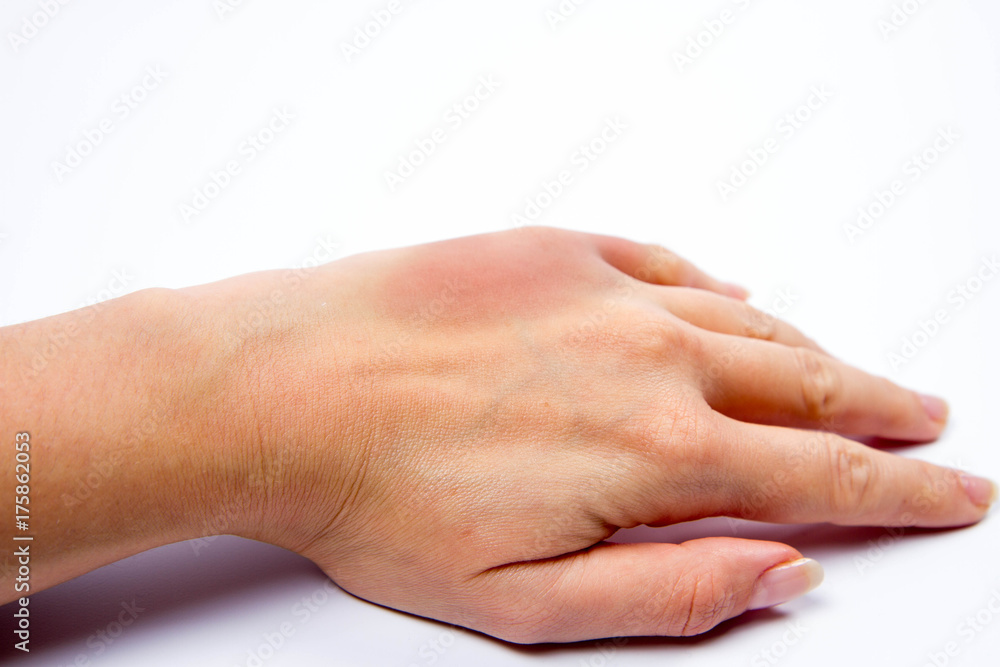 Woman's hand with a bruise Woman's hand with a bruise