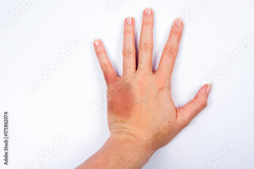 Woman's hand with a bruise
