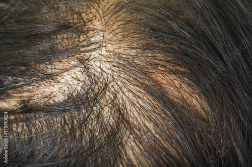 thin hair in women