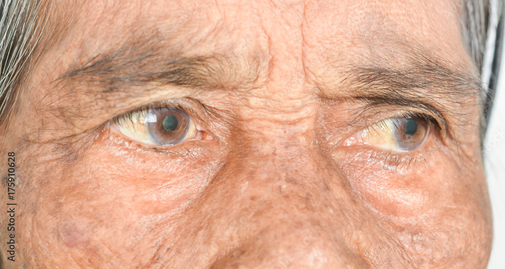 eyes in old patients. eyes in old patients.