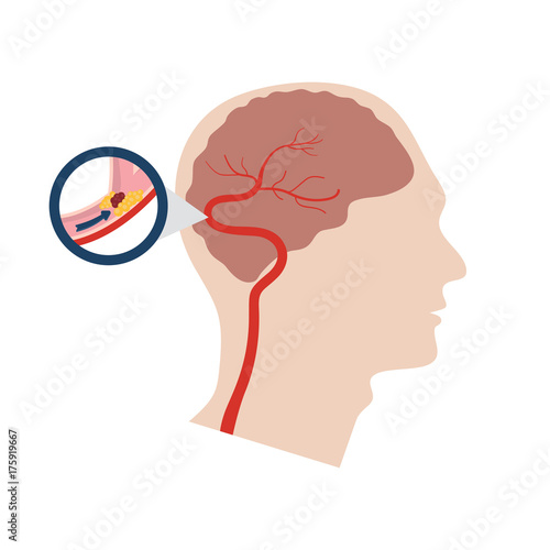 Vector illustration of a stroke photo