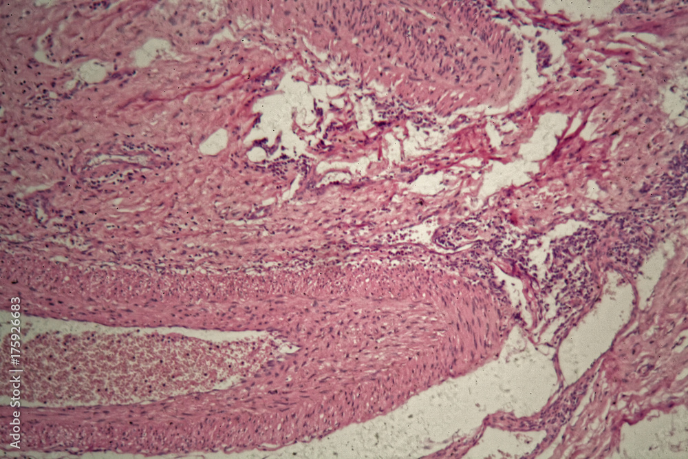 Stomach cancer cells under the microscope. Stomach cancer cells under the microscope.