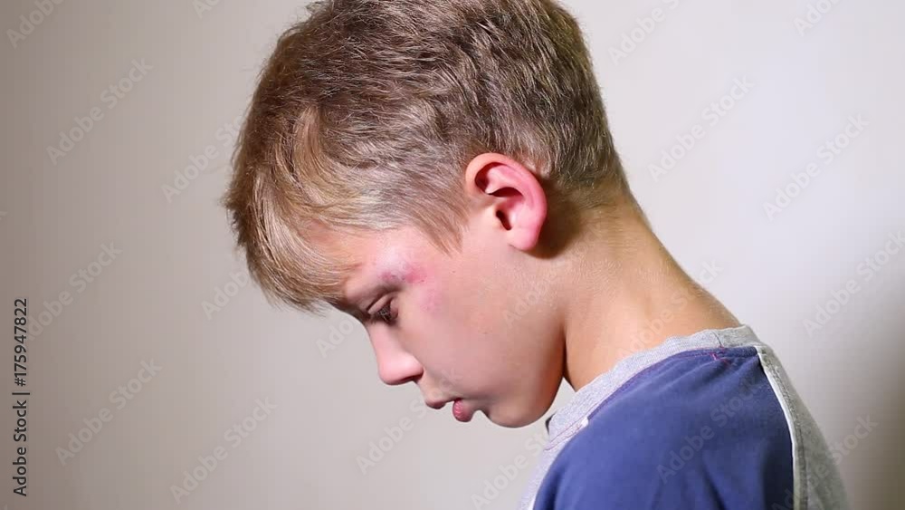 Closeup profile portrait of face of unhappy white kid with fresh blue and red bruise near eye. Sad little kid after fight covering eyes with hand sadly. Real time full hd video footage. Closeup profile portrait of face of unhappy white kid with fresh blue and red bruise near eye. Sad little kid after fight covering eyes with hand sadly. Real time full hd video footage.