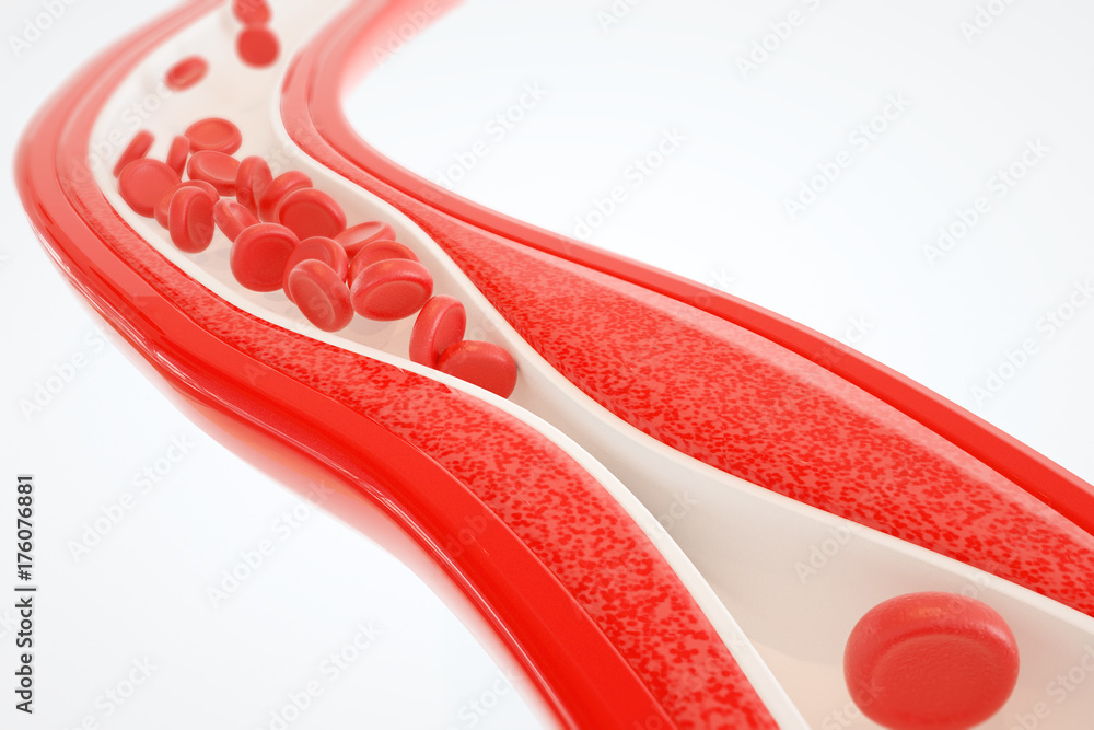 Angioplasty without stent placement- 3D rendering Angioplasty without stent placement- 3D rendering