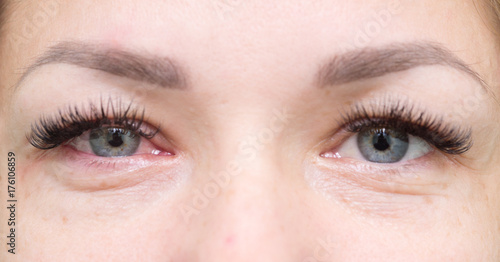 healthy and irritated eyes photo