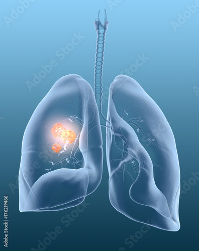 Lung cancer, medically illustration 3D on blue background