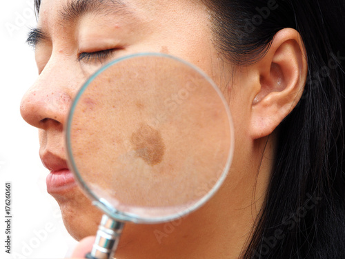 woman with magnifier focus on melasma skin
